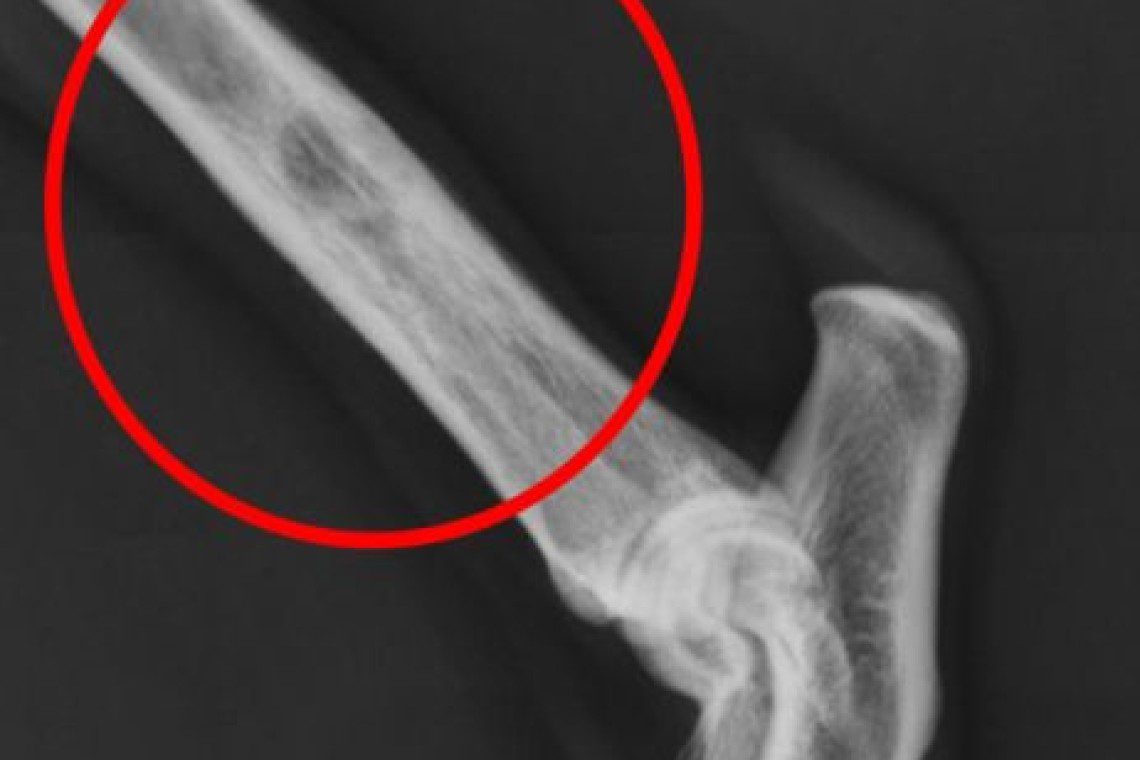 bone cancer bone cancer
