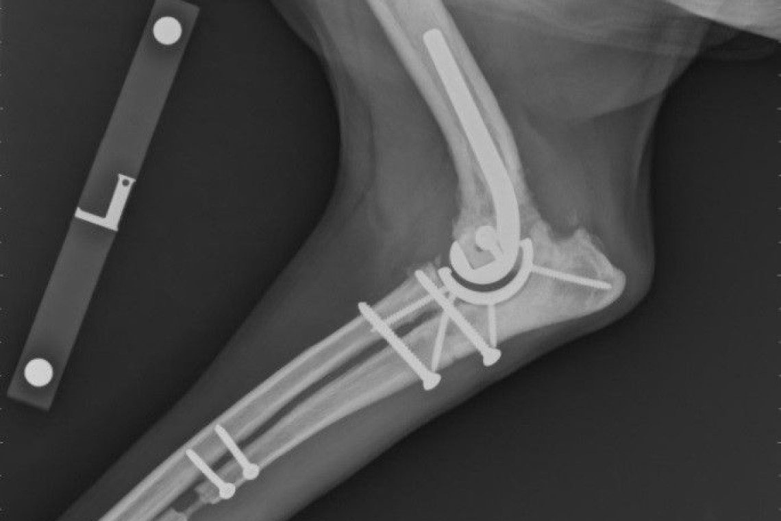 Radiographic illustration of Sirius Total Elbow Replacement