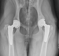 Radiograph of a bilateral total hip replacement