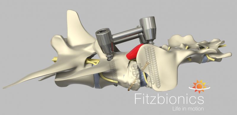 Lumbosacral distraction fusion using Fitz Bolt & Fitzateur System. Lumbosacral disease