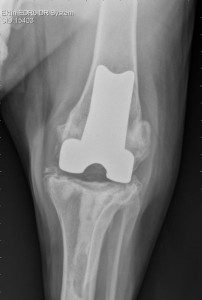 Radiographic illustration of BioMedtrix total knee replacement in the stifle