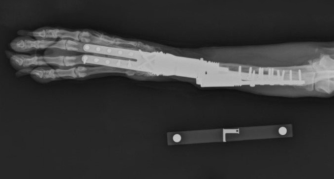 Radial-endo-3-yrs-post-op-original