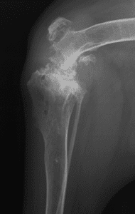 Radiograph showing end-stage degenerative joint disease in the stifle.