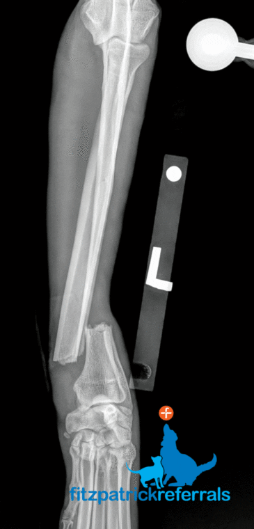 X-ray of a complete, displaced, transverse fracture of the left distal radius and ulna