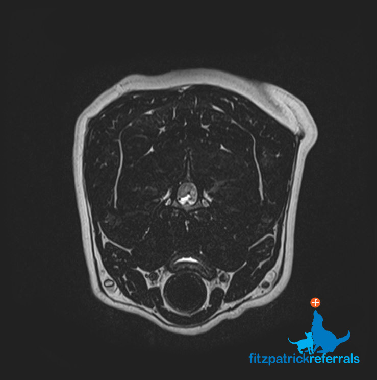 MRI scan of Labrador with Intervertebral Disc Disease - disc material visible on left side of canal