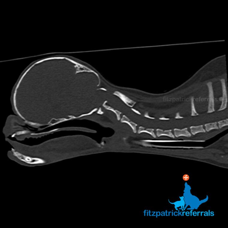 Pre-operative CT scan (sagittal view) showing a subluxation (severe kinking/ dislocation) at the C1-C2 level