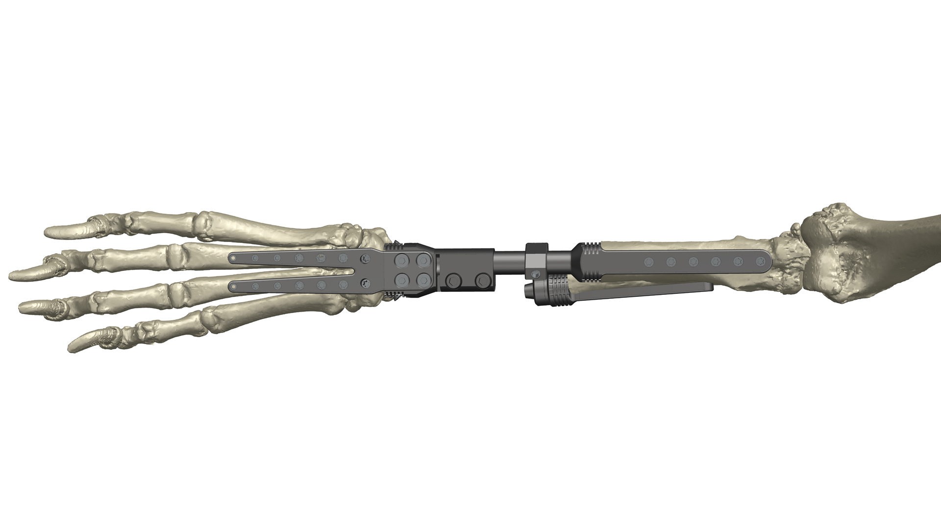 Radial endoprosthesis 3D reconstruction