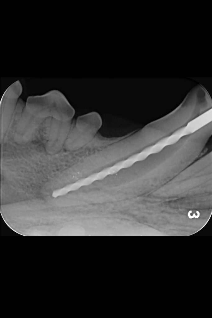 Intraoral radiograph of final endodontic file within the mandibular canine tooth showing adequate filling at the end of the root.