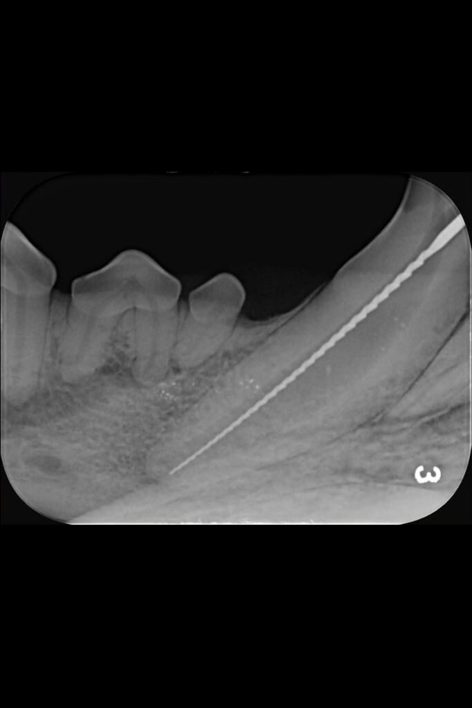 Intraoral radiograph showing determination of pulp canal length using small size endodontic file.