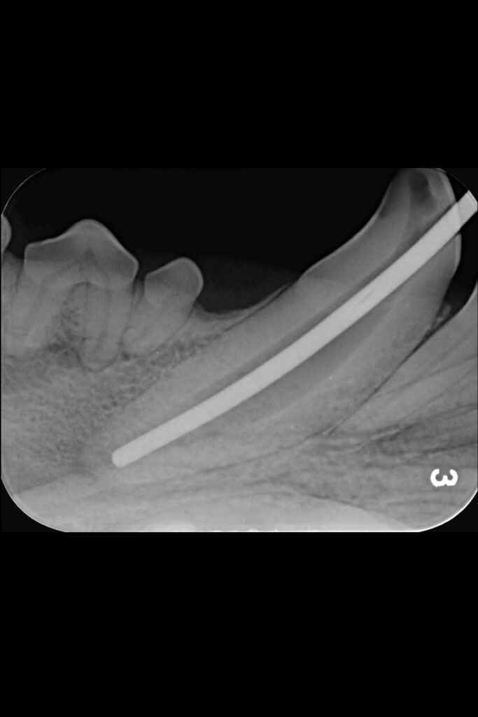 Intraoral radiograph of corresponding gutta percha point confirming adequate fit prior to final filling at the end of the root.