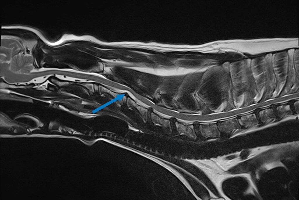 Sagittal C spine MRI image of a border collie dog with a hydrated disc extrusion