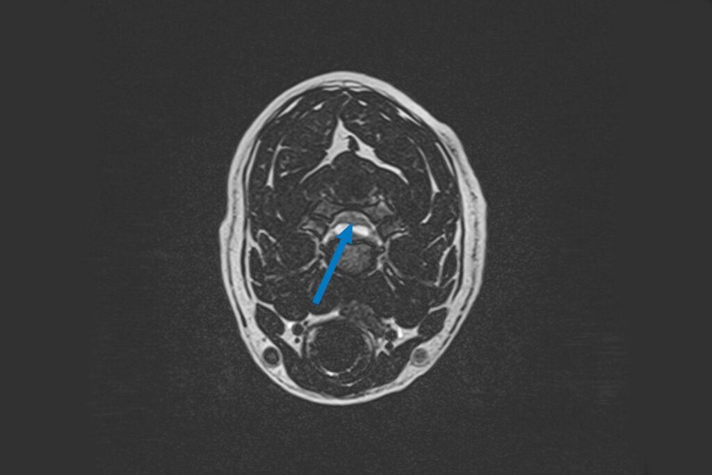 Transverse C spine MRI image of a border collie dog with a hydrated disc extrusion