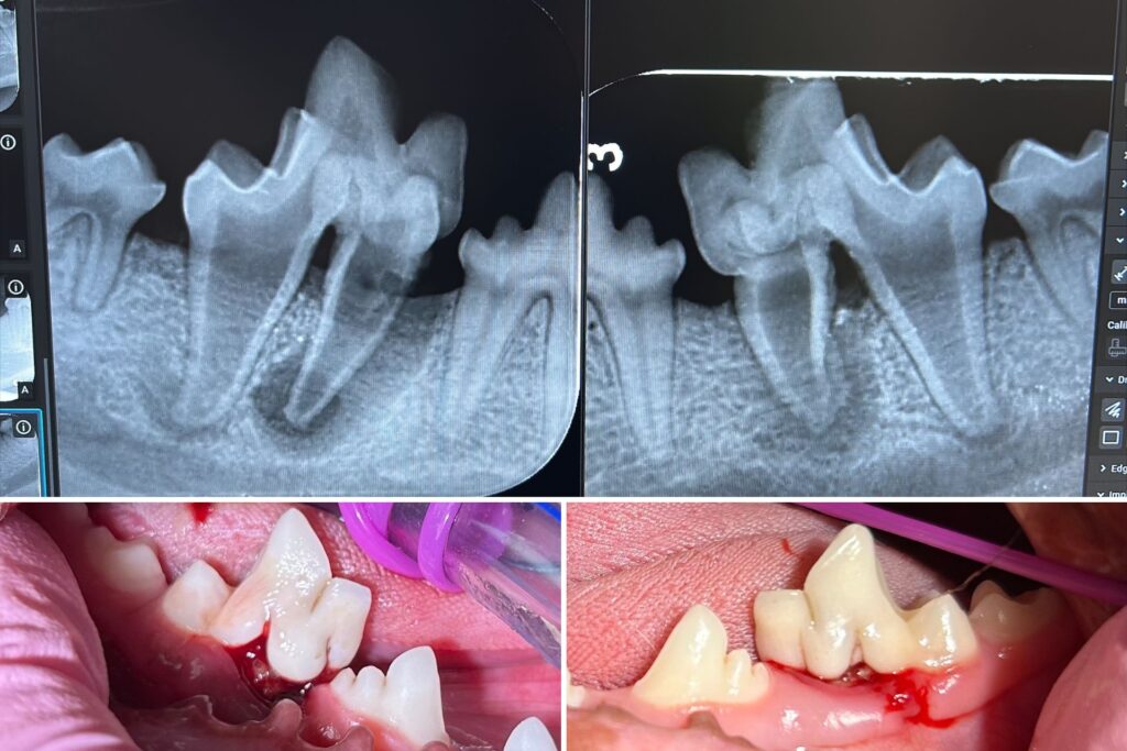 Dottie's teeth 1920x1280 Radiographs and photos of a dog with carnassial tooth malformation and advanced periodontal disease, showing severe inflammation of the bone around the roots and a draining abscess.