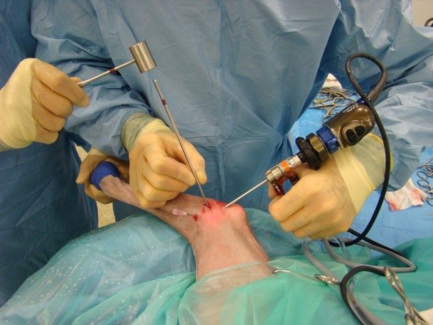 Arthroscopy - Fitzpatrick Referrals