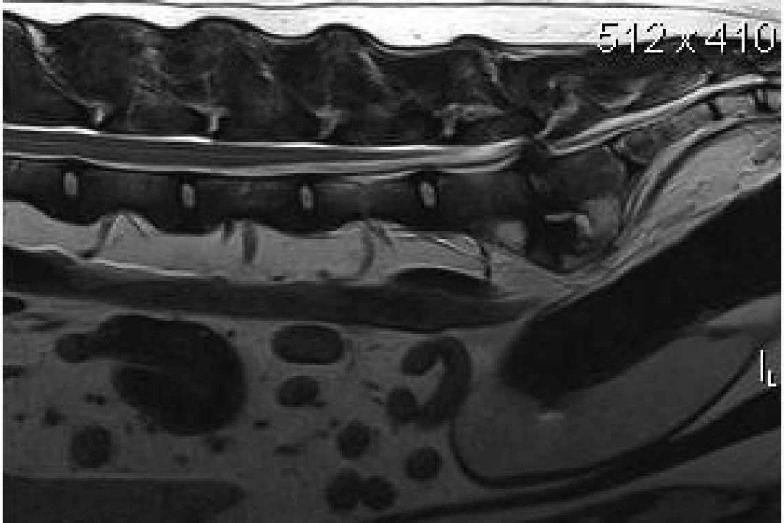 MRI image of the lumbosacral spine illustrating degenerative and compressive changes in the LS junction