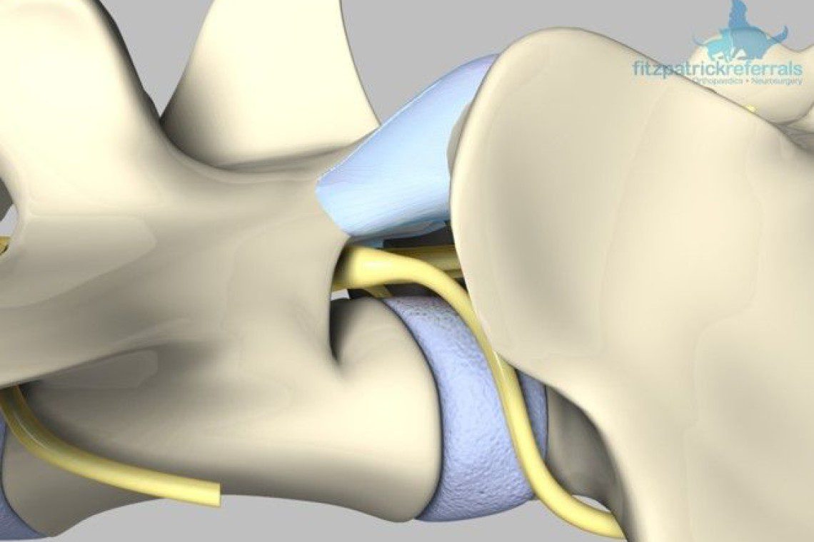 Lumbosacral Junction illustrating the lumbosacral disc in light blue and the nerve root in yellow.