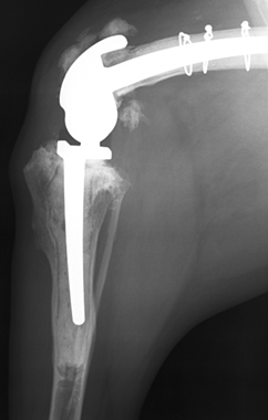 Custom Total Knee Replacement Implants