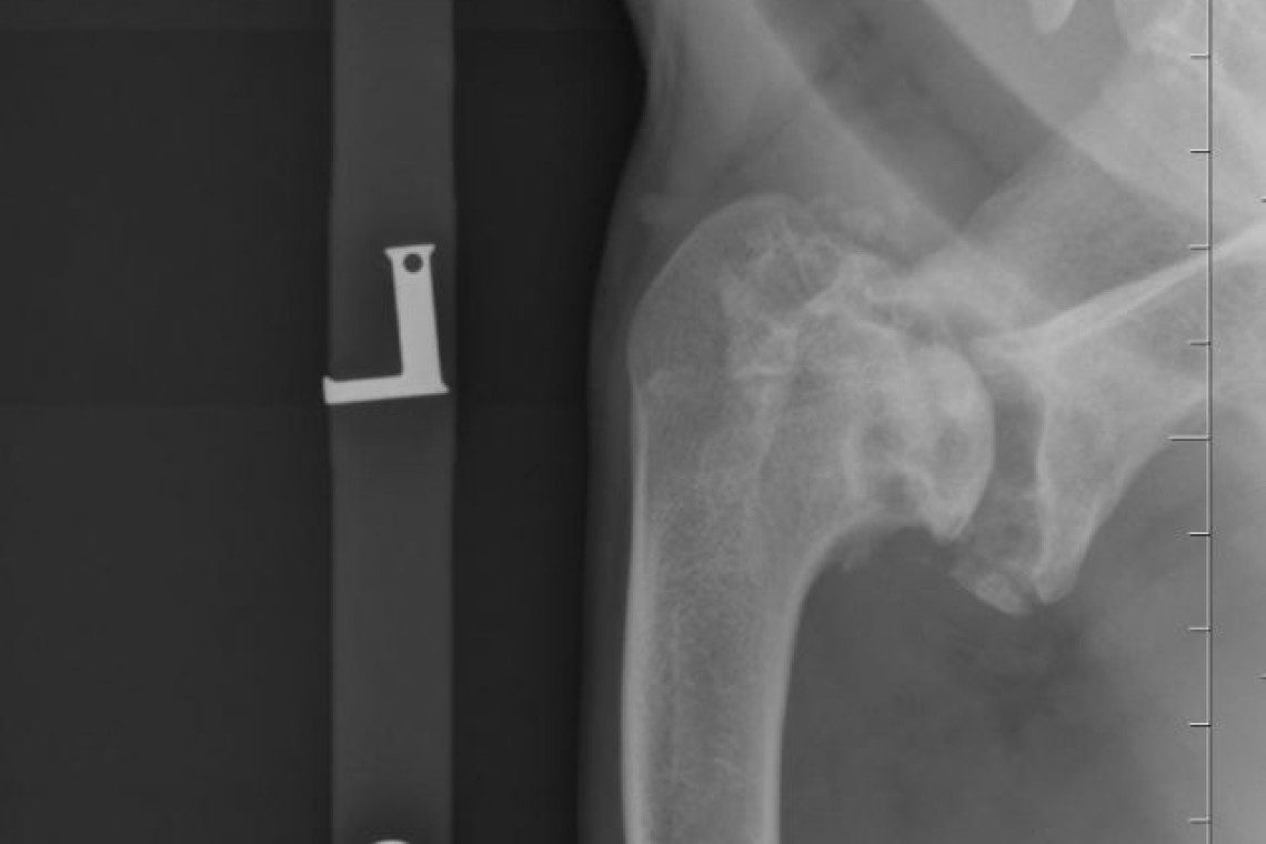 End-stage osteoarthritis of the shoulder joint