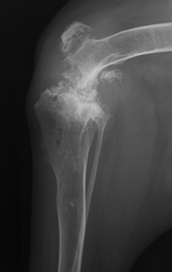 End Stage Degenerative Joint Disease in the Stifle