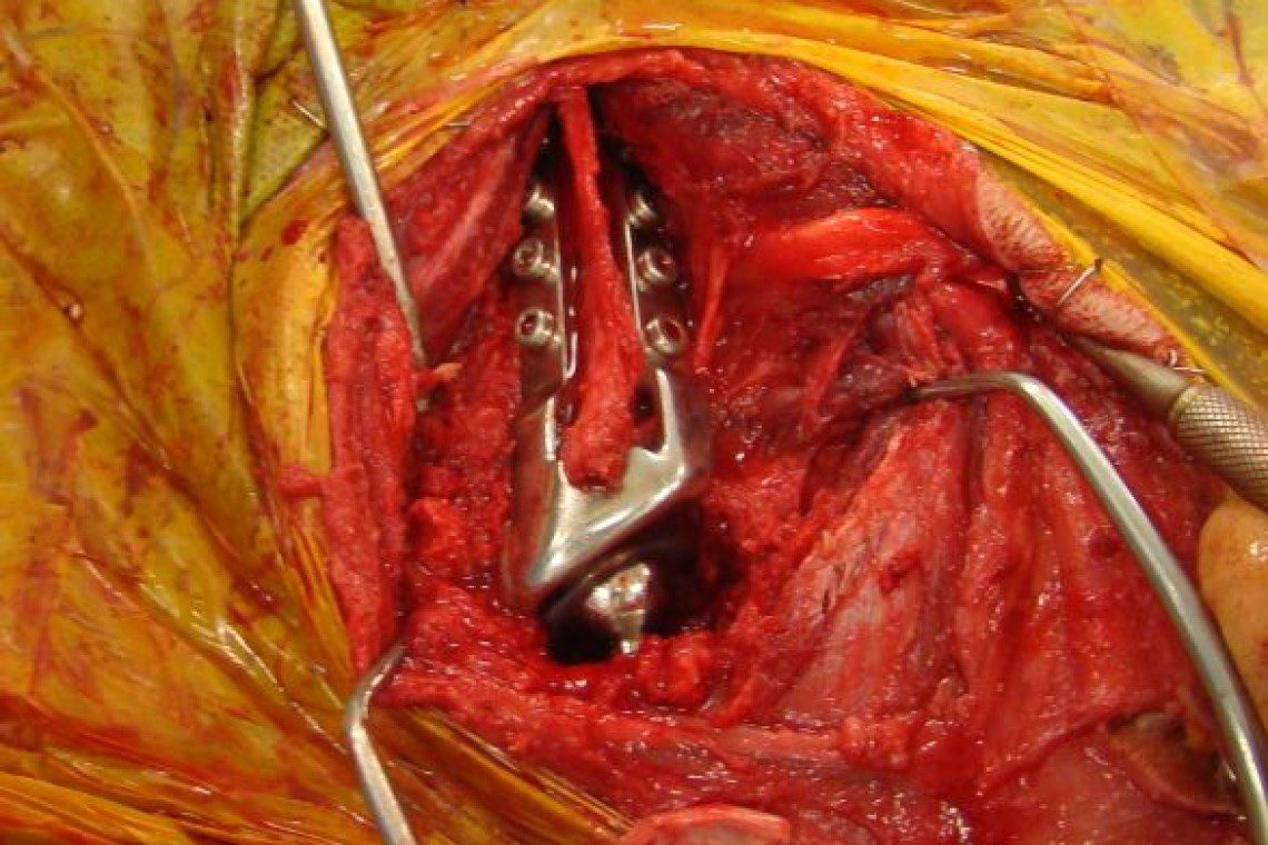 Illustration of the new shoulder 'ball and socket' joint in situ during surgery