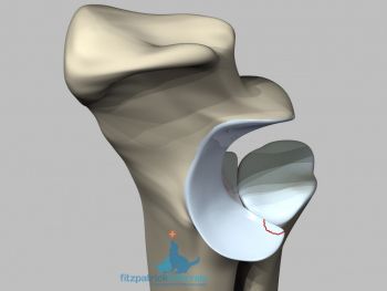 how to treat elbow dysplasia in dogs