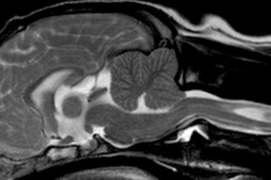 MRI scan illustrating Chiari-like malformation