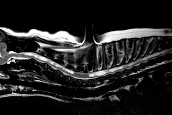 MRI of cervical and thoracic spine illustrating syrinx in the spinal cord