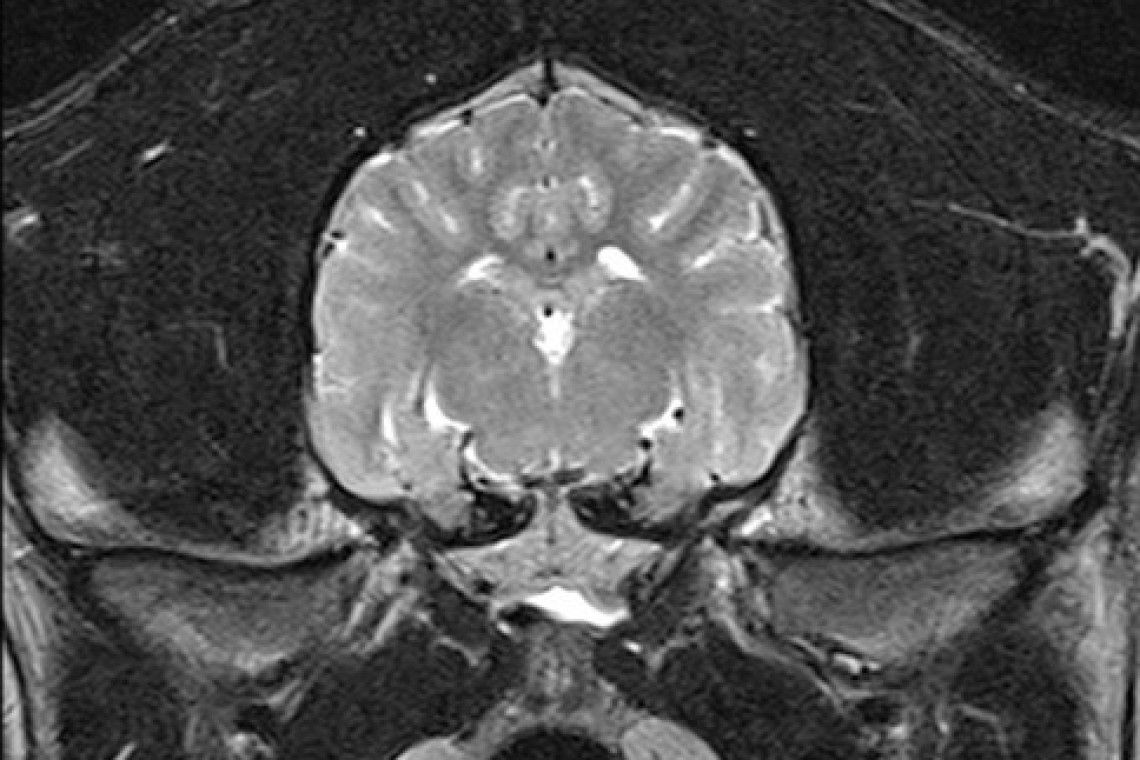 MRI scan of a normal brain