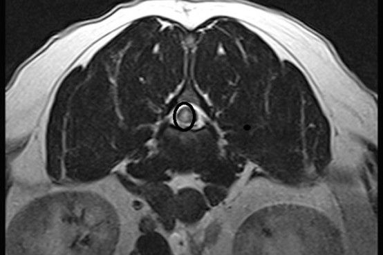 Transverse MRI indicating FCE in the thoracolumbar spine 
