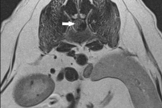 Hansen Type I IVD extrusion in the thoracolumbar spine. Hansen Type I IVD extrusion in the thoracolumbar spine