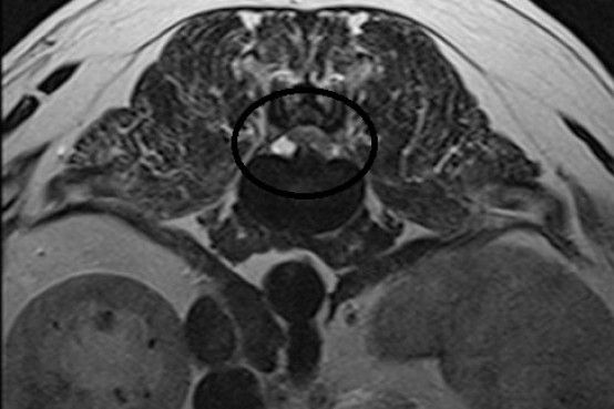 Hansen Type II disc disease MRI of thoracolumbar spine