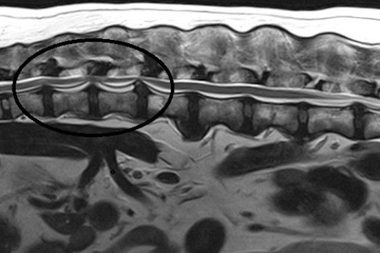 Hansen Type II IVD protrusion