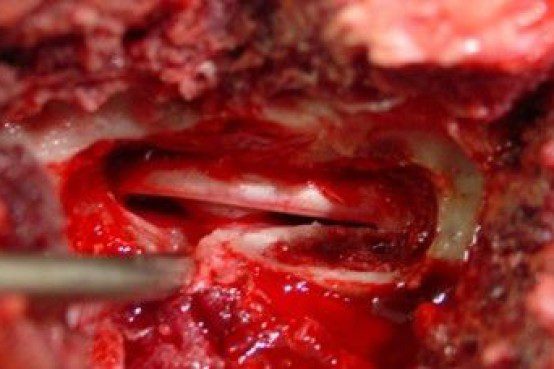 Hemilaminectomy window created during IVD extrusion surgery. 