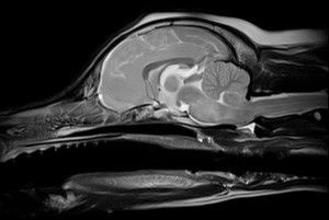 MRI of brain illustrating area of meningoencephalitis 