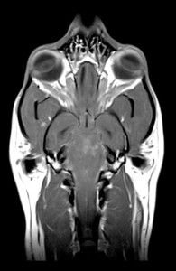 MRI of brain illustrating an area of meningoencephalitis 