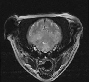 MRI of brain illustrating meningioencephalitis