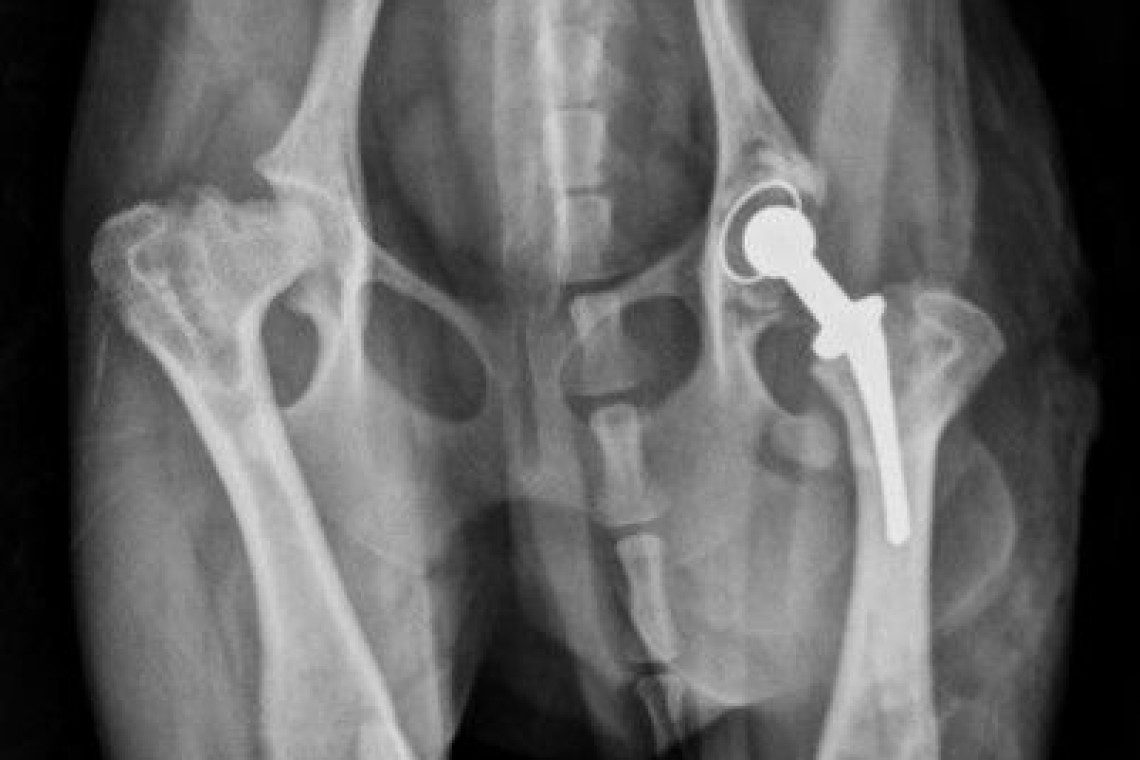 Illustration of Micro Total Hip Replacement implants in situ following surgery