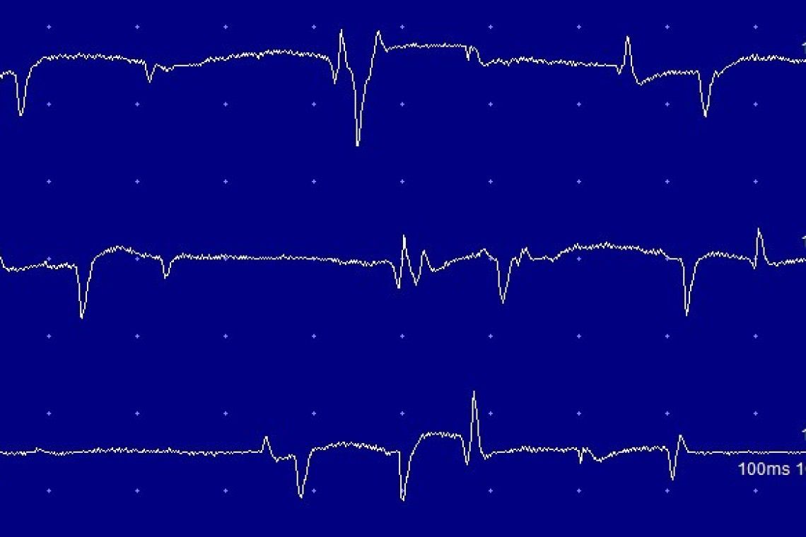 EMG recording from a muscle. The spontaneous activity indicates a neuropathy or myopathy