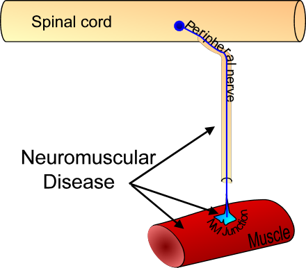 Neuromuscular Disease chart