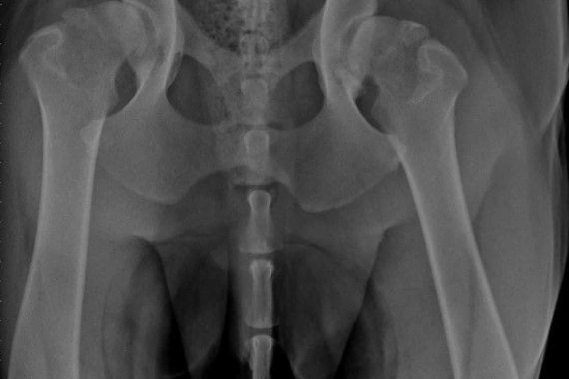 Bilateral Hip Osteoarthritis before Total Hip Replacement