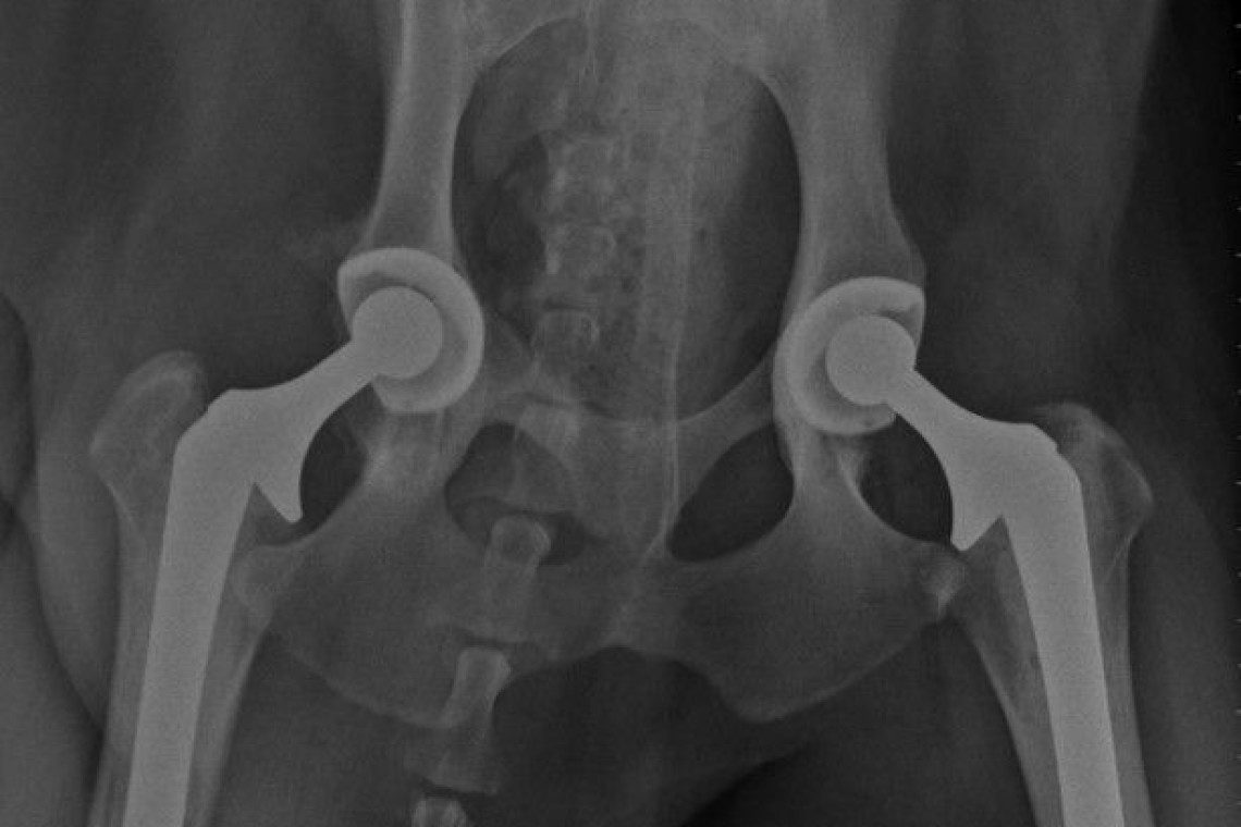 Radiograph of Total Hip Replacement. Surgeries were not performed at the same time but staggered once sufficient healing of the first surgery was determined