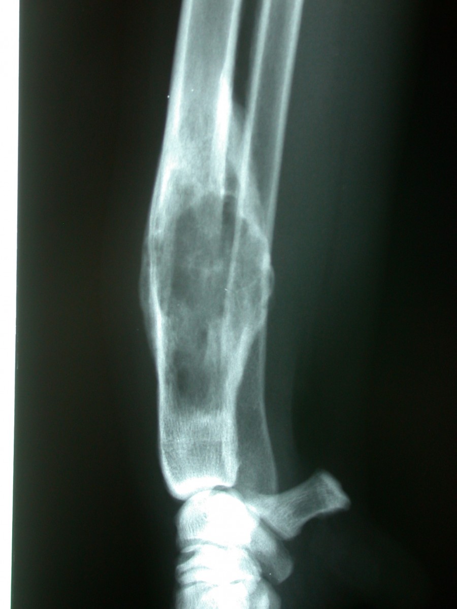 Radiograph illustrating distal radius osteosarcoma (OSA)