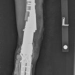 Radiograph of a radial endoprosthesis post operation Fitzpatrick Referrals