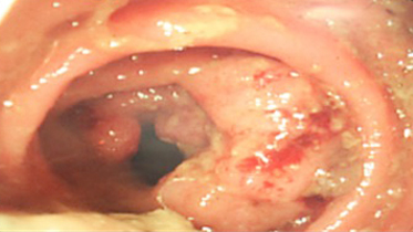 Colonoscopy of a partially circumferential mass lesion of the colonic wall.