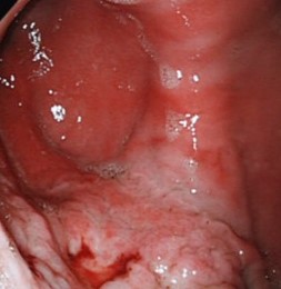 Endoscopy image of a stomach showing a gastric neoplasia with evidence of haemorrhage.