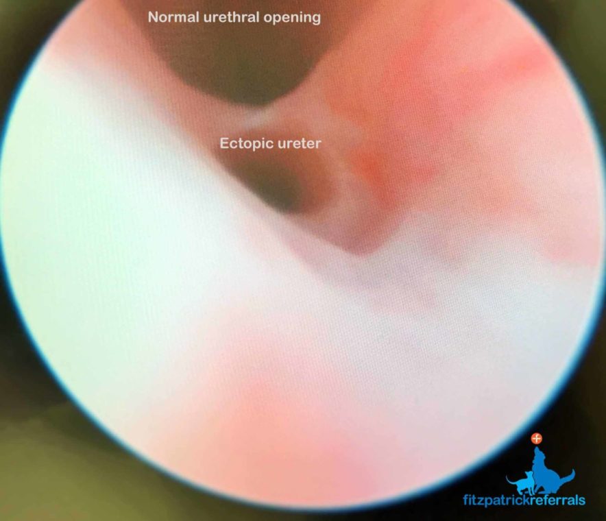 Cystoscopy image of a normal and ectopic ureter