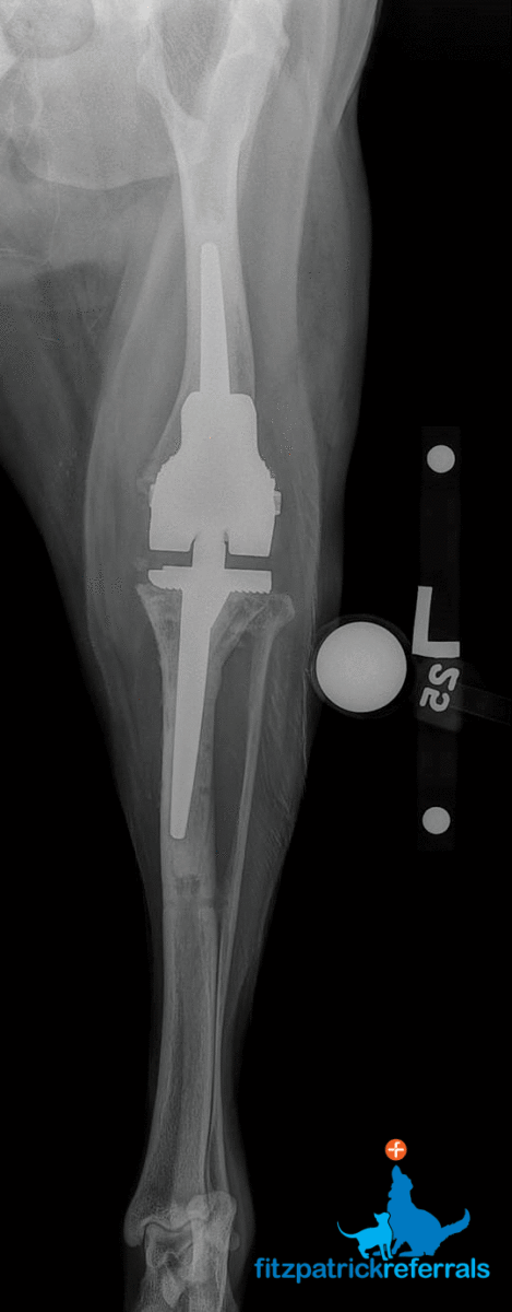 Radiograph custom hinged total knee replacement Fitzpatrick Referrals