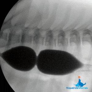 Fluoroscopic image of balloon inflated for oesophageal stricture Fitzpatrick Referrals