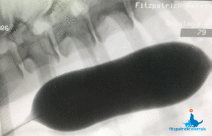 Fluoroscopic image of stricture almost completely opened by balloon Fitzpatrick Referrals