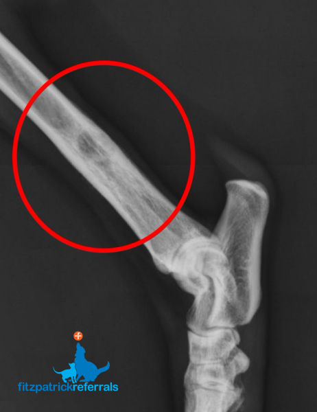 Distal Tibia Osteosarcoma radiograph